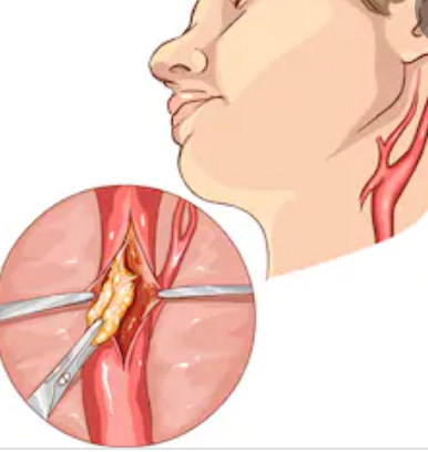 冠動脈バイパス術前の無症候性頸動脈狭窄の保存的管理と頸動脈内膜剥離 