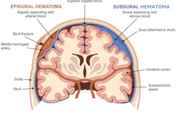 子宮頸部硬膜外ステロイド注射の候補者は誰ですか?