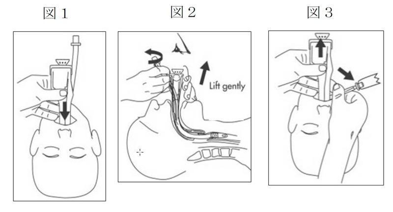 Ｑ：ビデオ喉頭鏡にはどんな種類があるのか？: 麻酔科勤務医のお勉強日記