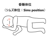 昏睡胎位.png