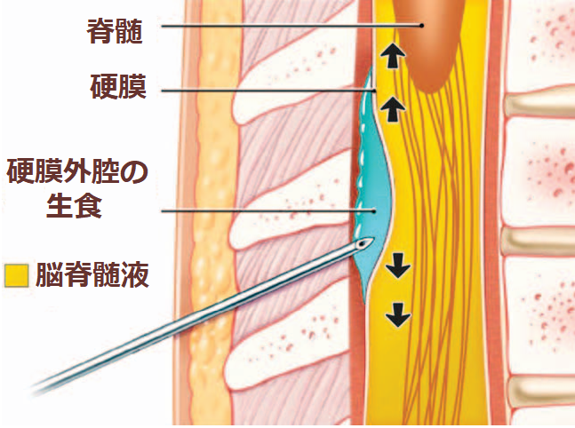 帝王切開術における硬膜外容量拡張が高比重性ブピバカインの必要 帝王切開術における硬膜外容量拡張が高比重性ブピバカインの必要