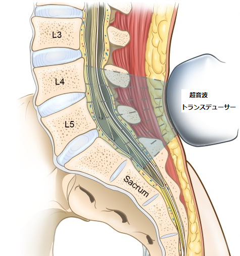 帝王切開分娩を受ける肥満妊婦における脊椎麻酔に際しての超音波