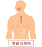 食道切除術.png