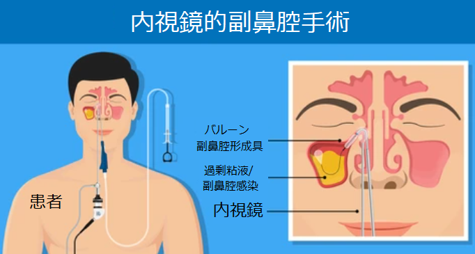 内視鏡下副鼻腔手術における術野視認性において、吸入麻酔は全身