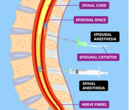 帝王切開分娩における硬膜穿刺硬膜外鎮痛、硬膜外鎮痛、脊椎硬膜外併用 